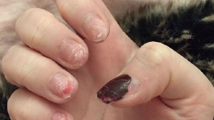 Are Damaged Nails Permanent?